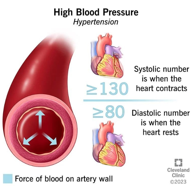 A Remote Blood Pressure Monitoring Device For Between Dr Visits